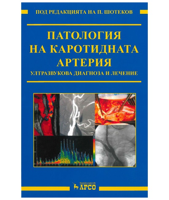 Патология на каротидната артерия. Ултразвукова диагностика и лечение